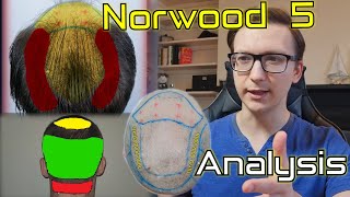 Norwood 5 Hair Transplant Expectations [upl. by Otecina]