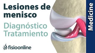 😩😩ROTURA DE MENISCO ► Diagnóstico y tratamiento de fisioterapia médico y quirúrgico [upl. by Shaia572]