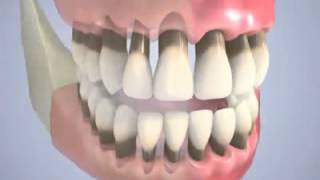 bruxism or clenching of teeth [upl. by Herminia]