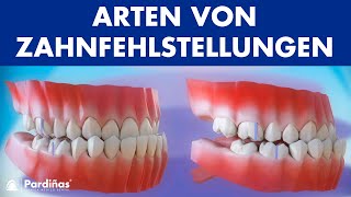 Zahnfehlstellungen – Arten von Zahnfehlstellung © [upl. by Taite]