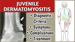 Juvenile Dermatomyositis Symptoms Diagnostic Criteria Complications and Treatment [upl. by Tneciv]