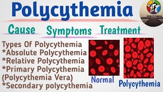 Polycythemia In Hindi ll Polycythemia Vera ll Hematology And Blood Banking [upl. by Martelle]