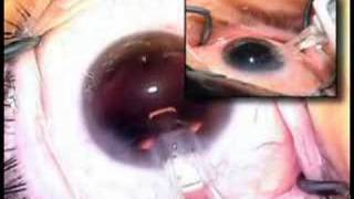 cataract surgery IOL insertion Uday Devgan MD lens implant [upl. by Bolme]