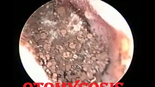 Severe Fungal infection Removal  Otomycosis ear cleaning by OtoEndoscopy [upl. by Silberman]