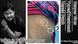 What is Pityriasis RoseaHerpes VirusHerald PatchTypes and Treatment in Hindi [upl. by Charpentier]