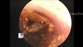 Enucleation embolization and external auditory canal cholesteatoma 12 minutes [upl. by Thgirw416]