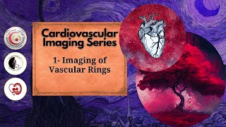 Imaging of Vascular Rings [upl. by Yhtak]