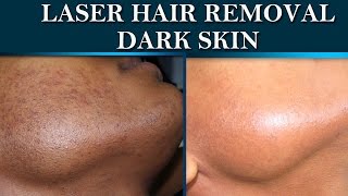 Laser hair removal at Dermalogics Before amp After on dark skin [upl. by Vivianne405]