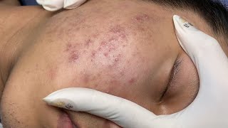 ACNE TREATMENT VU QUYNH MI Acne On Boys Chin 2024 [upl. by Adnilemre677]