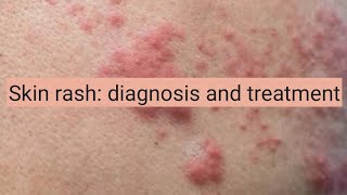 Skin Rash diagnosis and treatment [upl. by Aihsenod7]