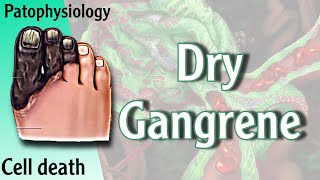 Dry Gangrene Necrosis شرح [upl. by Daile605]