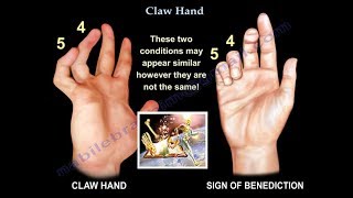 Claw Hand Ulnar Claw Hand  Everything You Need To Know  Dr Nabil Ebraheim [upl. by Omar]