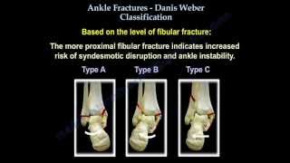 Ankle Fractures Danis Weber Classification  Everything You Need To Know  Dr Nabil Ebraheim [upl. by Oluas]