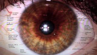 Iridology Reading Part I [upl. by Vani]