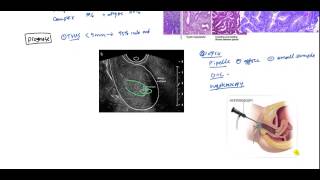 Endometrial Cancer and Hyperplasia for USMLE [upl. by Anilorac]