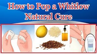 How to Pop a Whitlow Natural Cure [upl. by Fredra]