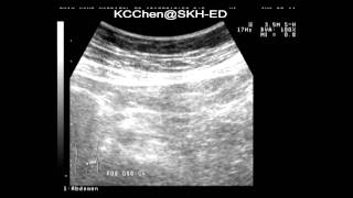 Epiploic appendagitis [upl. by Witty]