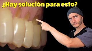 Desgastes en el cuello de los dientes  Causa y Solución  Abfracción Dental [upl. by Ynohta]