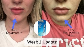 Differin Gel Retinoid Treatment  Week 2 Update [upl. by Emmit463]