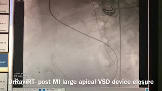 DrRaviRT Large Post Myocardial Infarction Apical VSD transcatheter device closure [upl. by Faludi399]