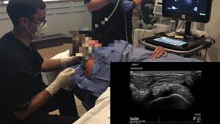 Ultrasound guided aspiration and lavage of calcific tendinitis [upl. by Riegel]