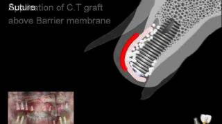 Clinical application of the Dentium graft materials [upl. by Ymmat]