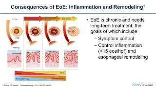 The Latest on New Options for Eosinophilic Esophagitis Considering Targeted Biologic Therapy [upl. by Aihtekal747]