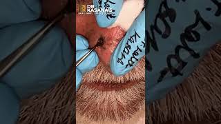 Nose Blackheads  Removal by DrLalit Kasana [upl. by Ad]