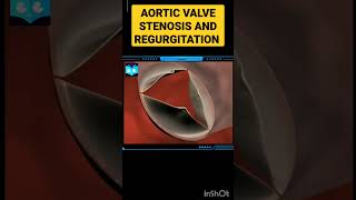 Aortic Valve Stenosis And Regurgitation  Animation  shorts Biology [upl. by Yelhs]