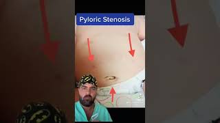 Learn Pyloric Stenosis Surgery [upl. by Suirradal]