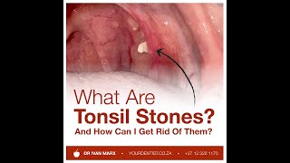 What are Tonsil Stones And how can I get rid of them [upl. by Cannon]