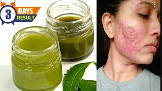 Acne and scars treatment naturally at home How to get spot less glowing skin [upl. by Harpp]