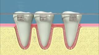 bodily tooth movement x264 [upl. by Akiem]