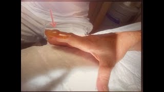 Paronychia Abscess Drainage A didactic video for young surgeons [upl. by Sierra589]