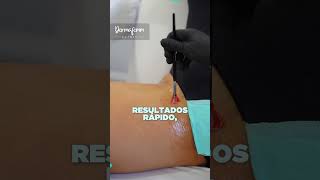 Peeling químico despigmentante para aclarar las manchas en la entrepierna ✅ [upl. by Burnsed]