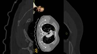 Identificando tromboembolismo pulmonar TEP na angiotomografia de tórax  protocolo TEP short [upl. by Arahsal99]