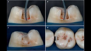 Class II Amalgam Preparation [upl. by Oidivo]