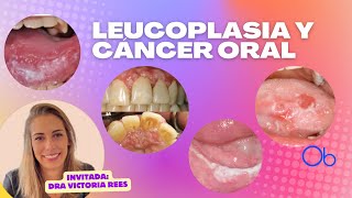 Leucoplasia y Cáncer Oral 👄 con Dra Victoria Rees [upl. by Eecyac]