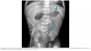 Duodenal Atresia or Stenosis Imaging [upl. by Einnalem]