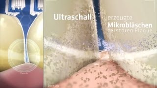 So funktioniert die Zahnreinigung mit echtem Ultraschall  emmident [upl. by Sell]