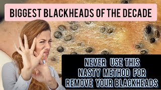 Nasty and lengthy blackhead removal bent needle historical method DrAMAZINGSKIN [upl. by Zabrina]