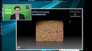 Curso CT infectologia  16 Mucormicosis [upl. by Nolly246]