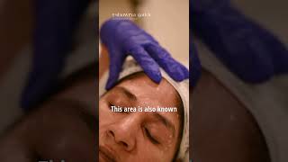 Brow lift using Botox [upl. by Rimola]