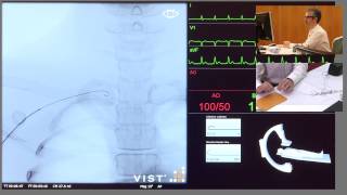 Catheterisation of Left Coronary Artery [upl. by Zia]