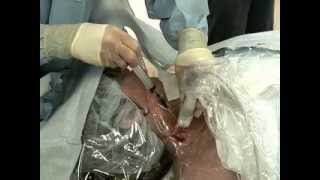 Placement of Central Venous Catheter  NEJM [upl. by Kovacev]