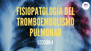 4 FISIOPATOLOGÍA DEL TROMBOEMBOLISMO PULMONAR FISIOPATOLOGÍA RESPIRATORIA [upl. by Yelrahs910]