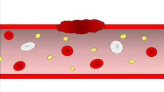 Hemostasis  Helpful Blood Clotting [upl. by Aerdnwahs]