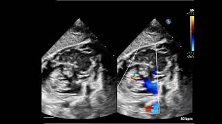 【TTE】cAVSD：complete atrioventricular septal defect【echo】 [upl. by Talanian930]