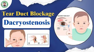 Dacryostenosis  Tear Duct Blockage  छोटे बच्चों को आँख से पानी बहना  Blocked Tear Duct [upl. by Heinrike473]