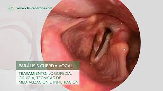 Disfonía Lesiones de las cuerdas vocales [upl. by Pavia]